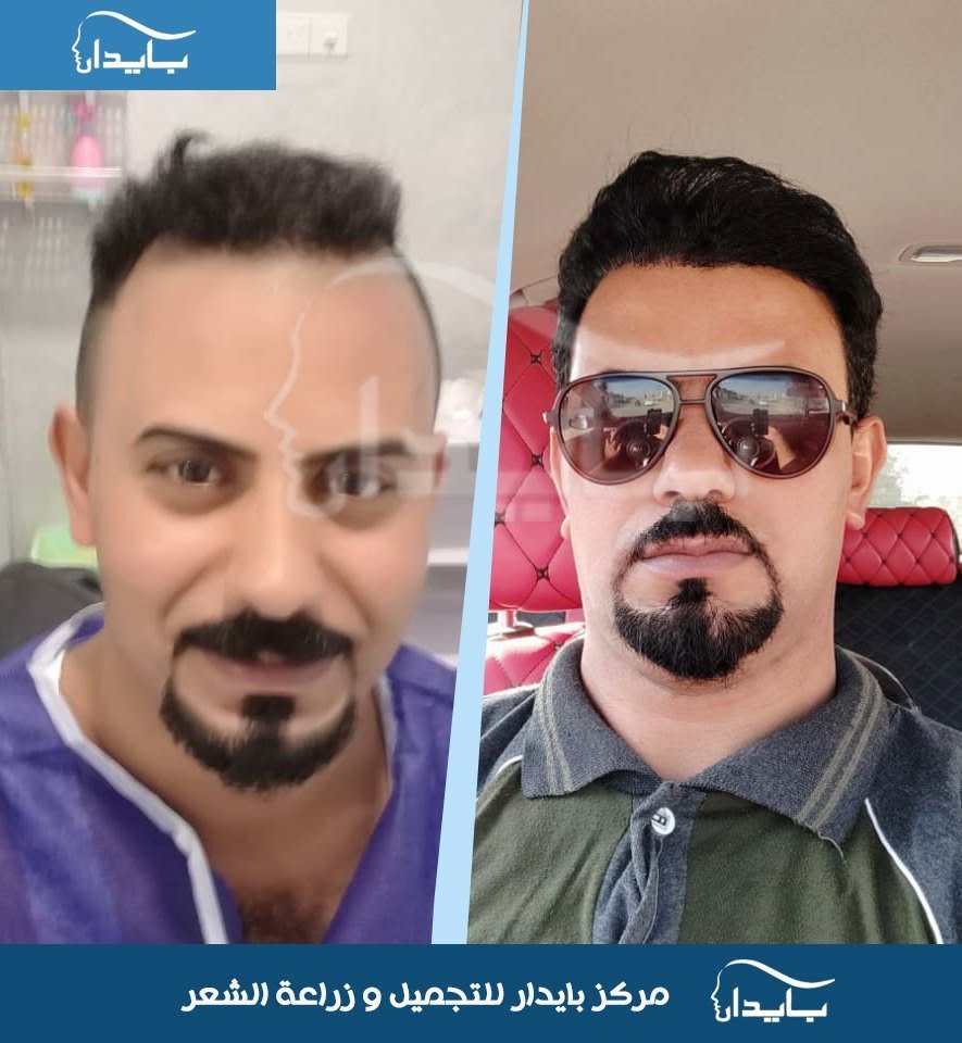 نتيجة حقيقية قبل وبعد زراعة الشعر - حالة 4